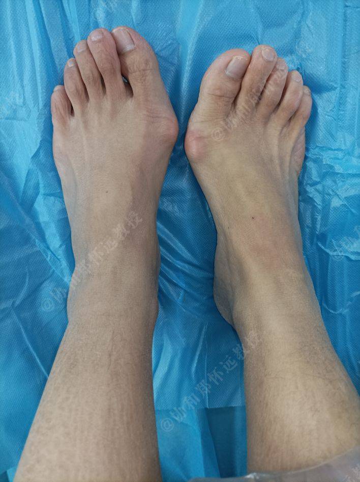 协和郑怀远|39岁做拇外翻微创矫正手术,记录术前术后三个月