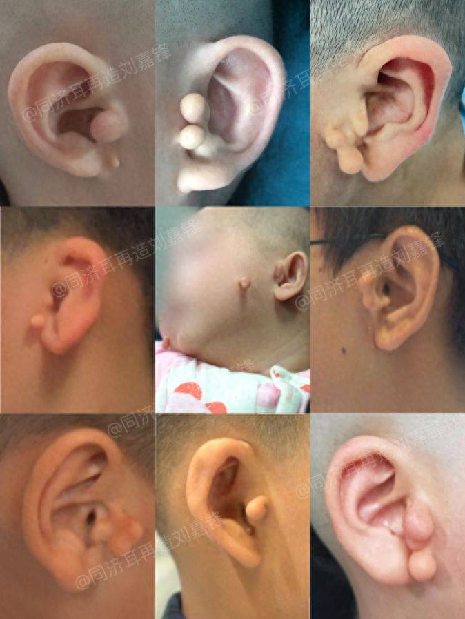 切掉附耳=赶走"福气"?