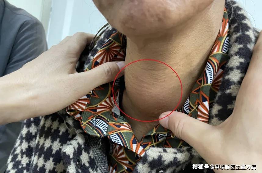 出现这几个症状,说明你的甲状腺结节已经加重了!
