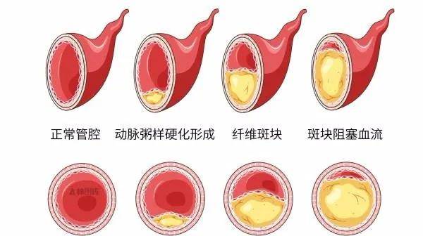 颈动脉狭窄程度图片