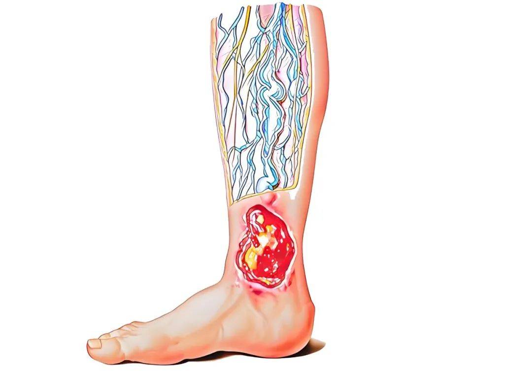 鑫巴克重组Ⅲ型人源化胶原蛋白用于大隐静脉曲张合并小腿溃疡愈合