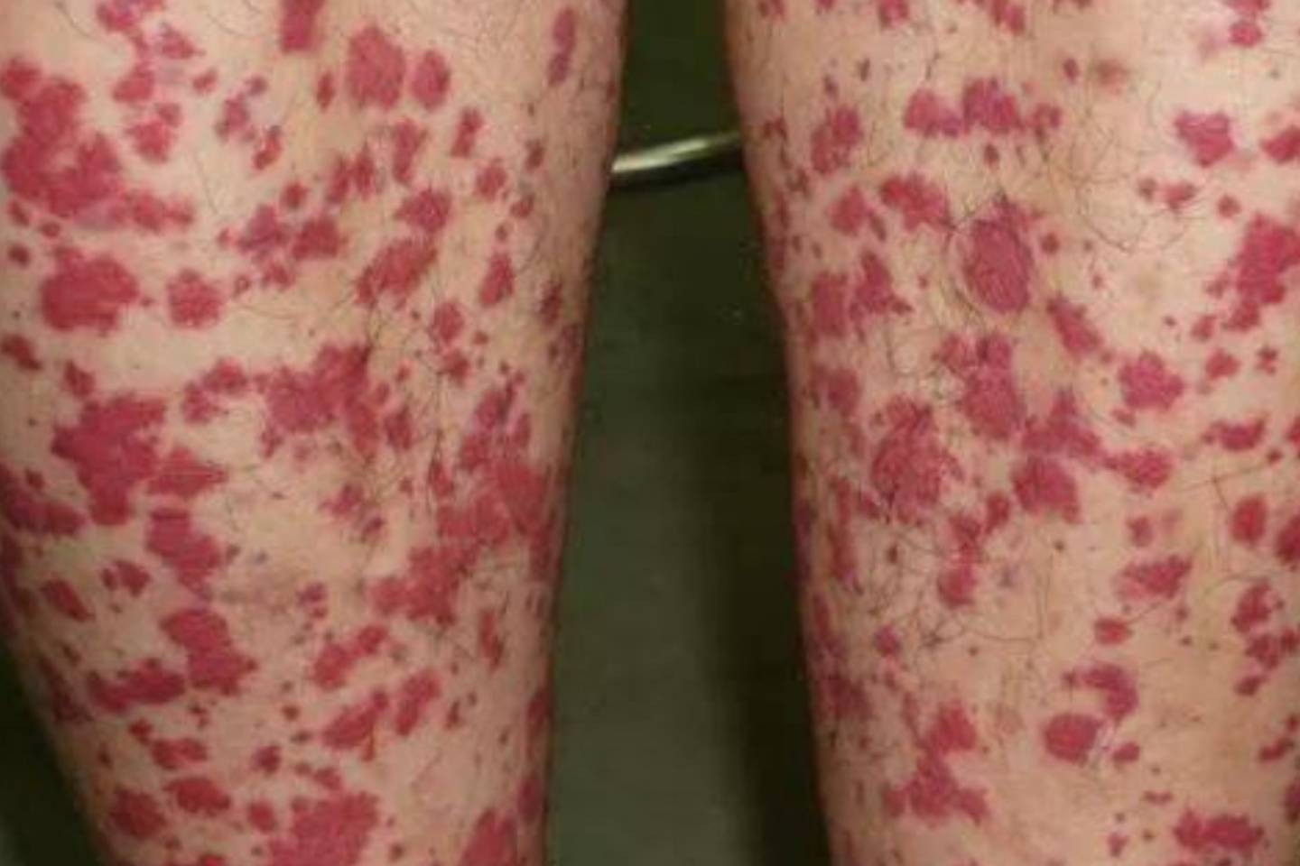 过敏性紫癜这种病严重吗?