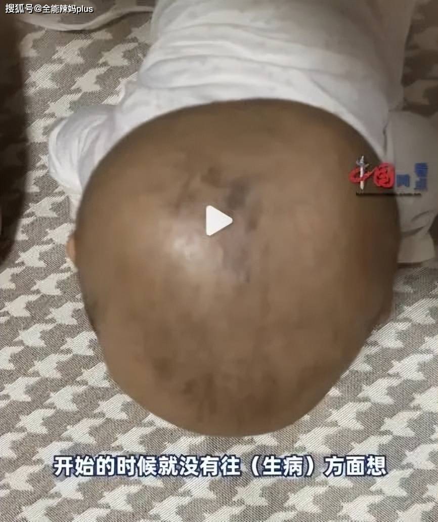 妈妈晒女儿"大小头",网友一眼看出问题,医生:幸好来得早