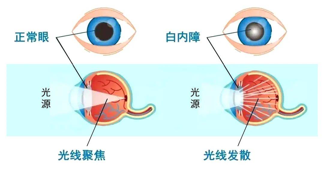 白内障,每个人都跑不掉?当眼睛有这3大变化就该上心了