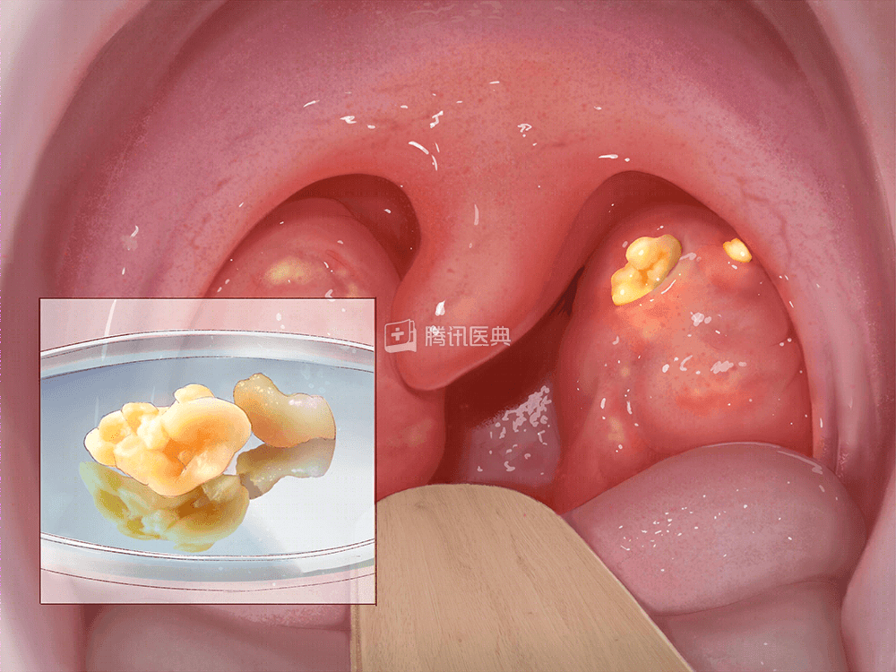 扁桃体隐窝凸起小肉芽图片