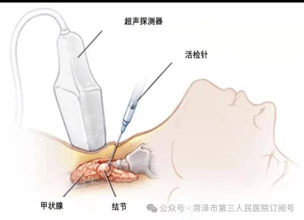 甲状腺穿刺怎么做图片