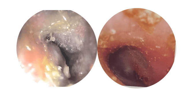 耳膜穿孔结痂图片图片