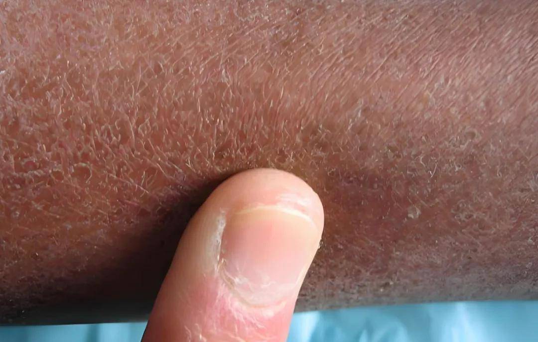 很多硬皮病患者,尤其是系统性硬皮病患者,多年以来一直没有改善,甚至