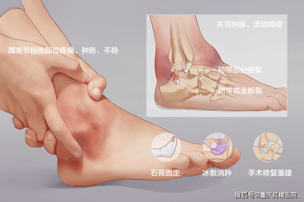 怎样处理扭伤的脚踝?_损伤_弹力_关节