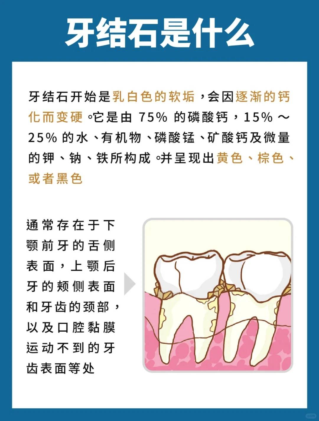 年轻人牙齿钙化的原因图片