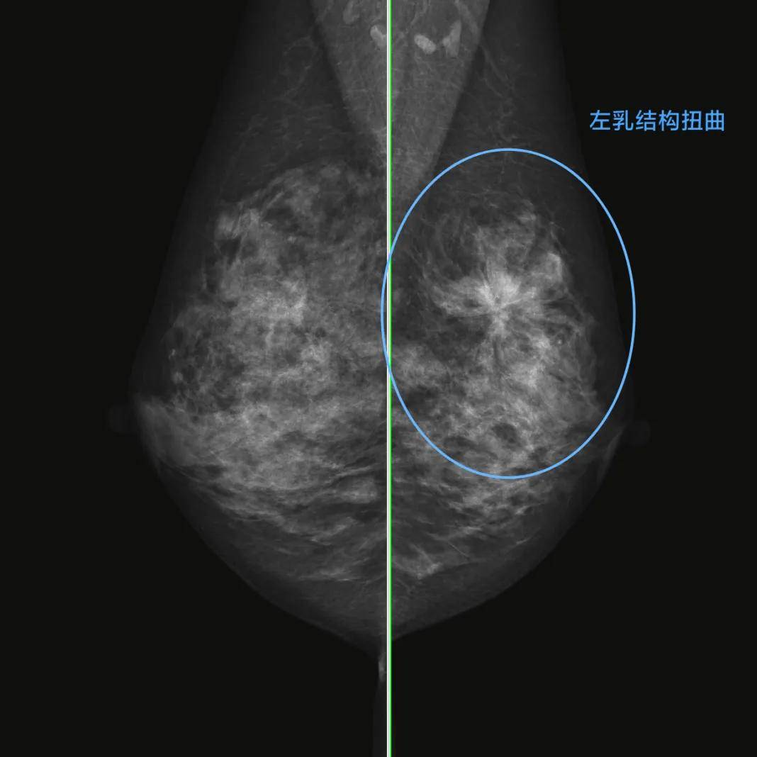 乳腺导管瘤 真人图片