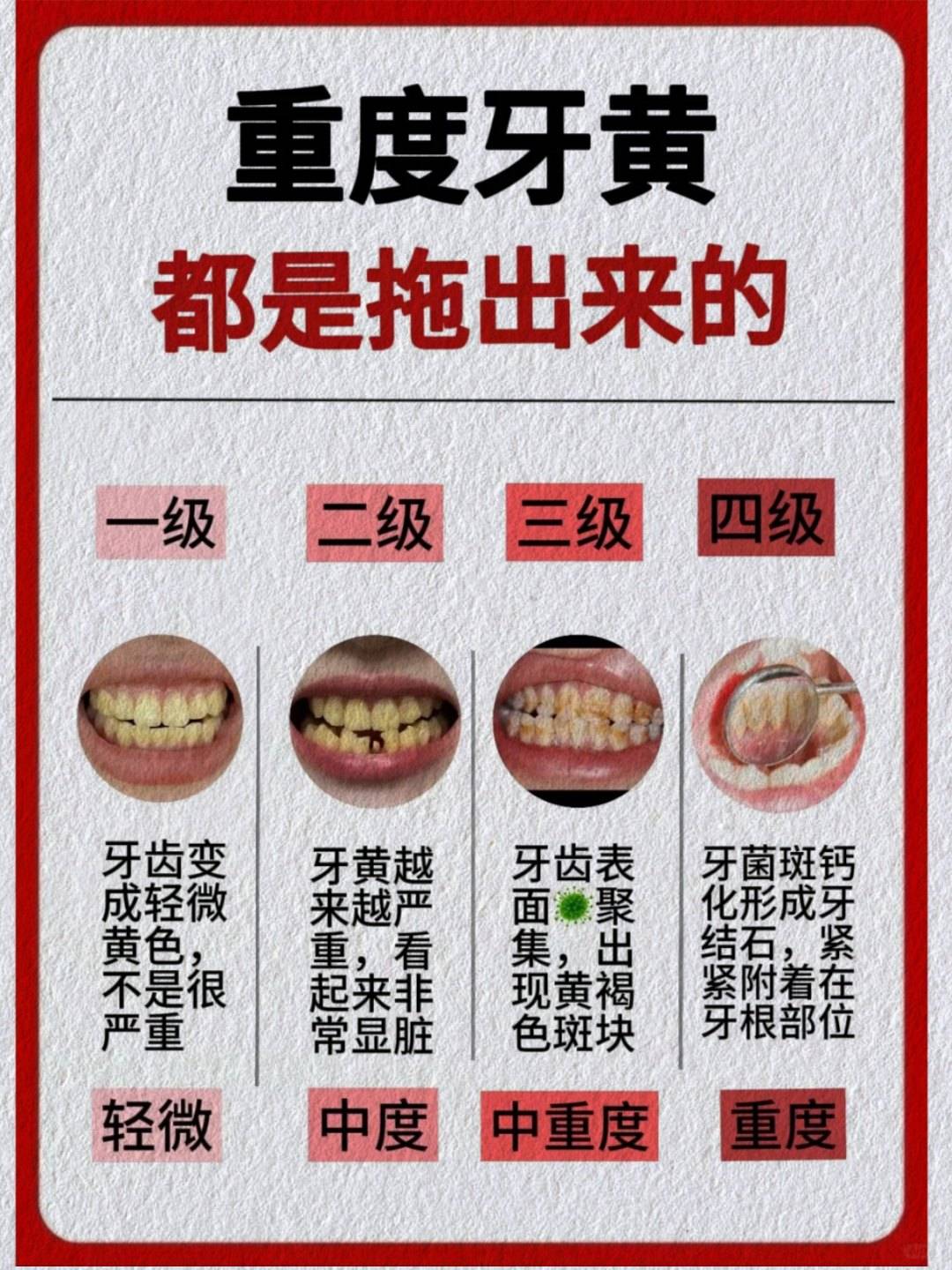 年轻人牙齿钙化的原因图片