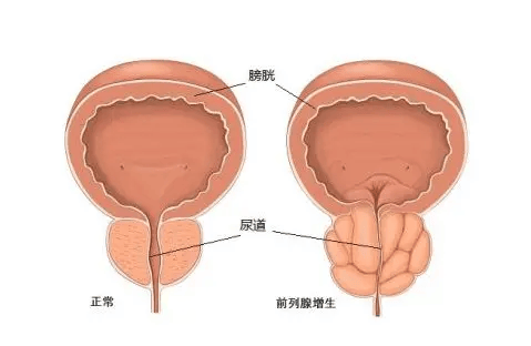 男性前列腺炎位置图图片