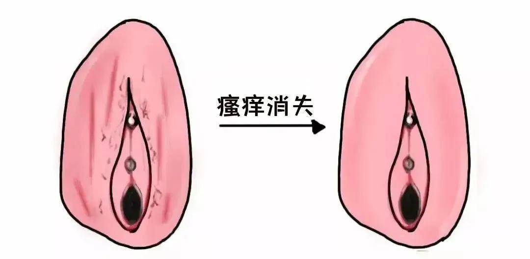 外阴白斑是什么症状图片