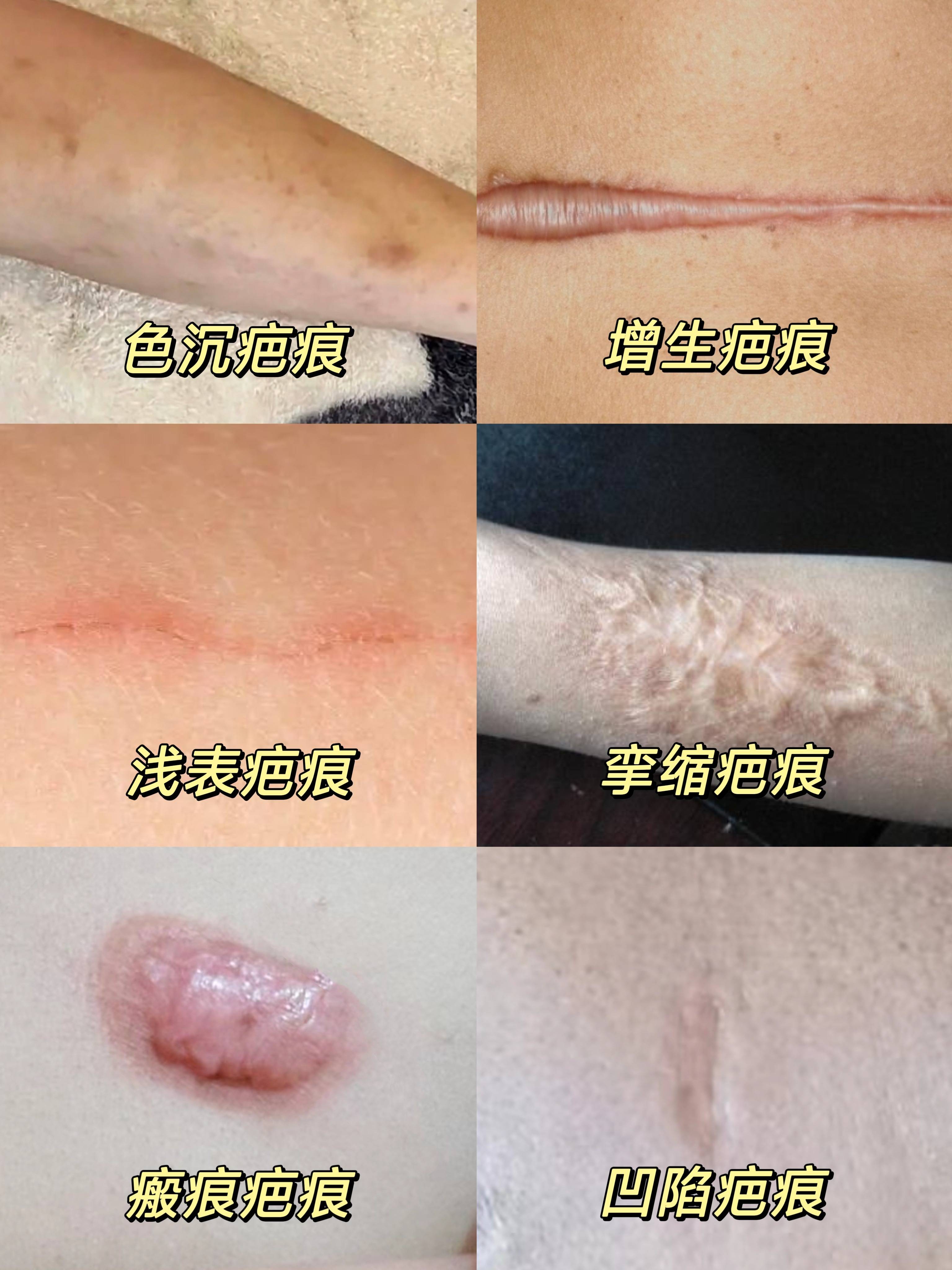 6种常见疤痕你是哪种附超全改善方法