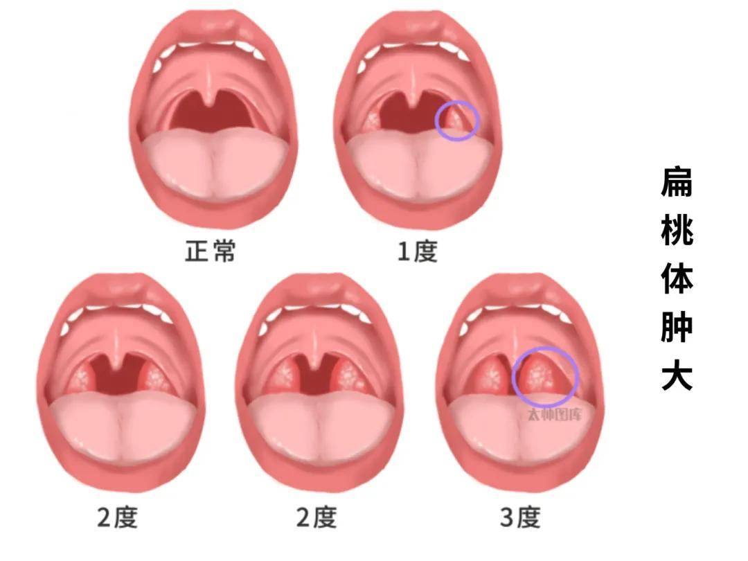 扁桃体癌早期图片大全图片