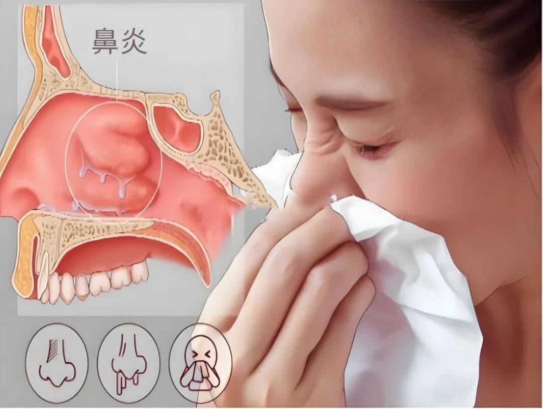 鼻塞不透气,犹如"水泥封鼻孔"教你一招快速缓解