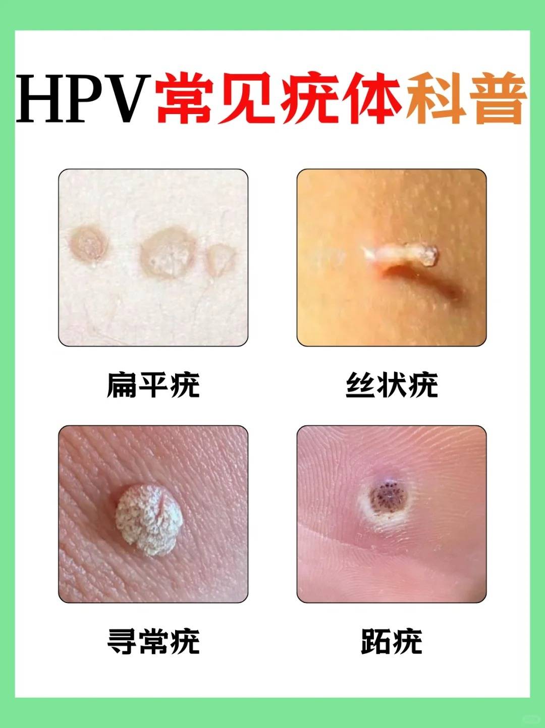 假疣和真疣的区别图女性的简单介绍 假疣和真疣的区别图女性的简单

先容
（假疣和真疣的区别图知乎） 女性