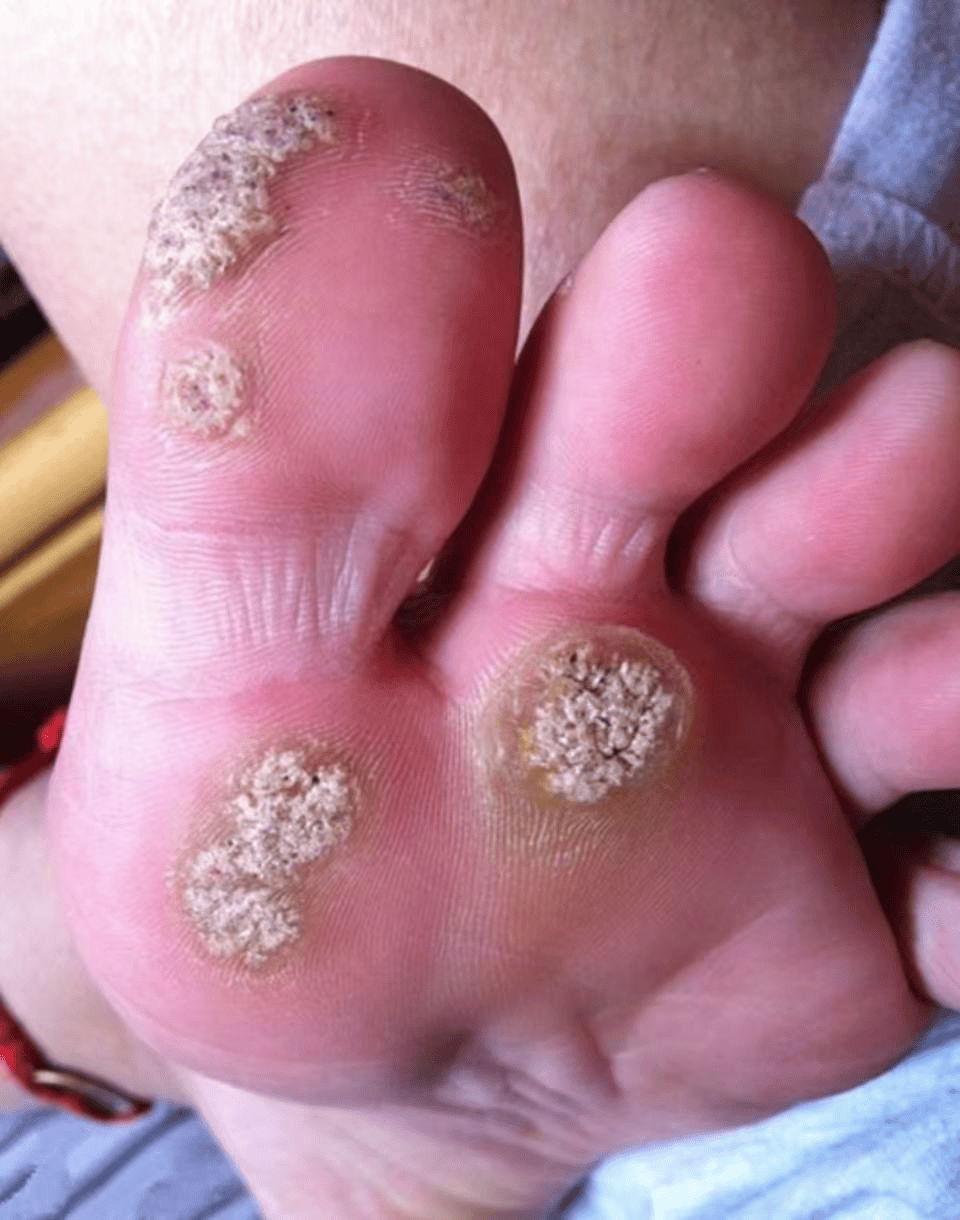 身上5种小疙瘩可能与hpv感染有关:如何识别和预防?