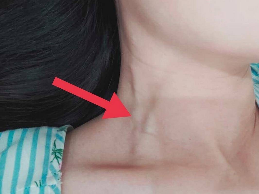 过程中反映,自己总感觉脖部两侧的血管比以前更明显,尤其是静脉部分