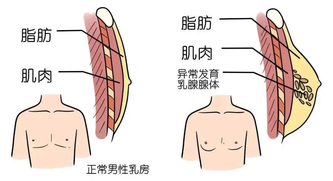 男性乳腺腺体发育图片