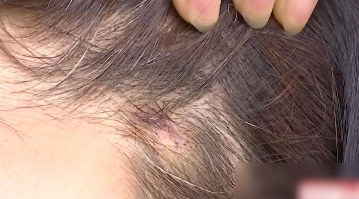 拉皮后眉毛不能动 宁波鄞州童颜医疗美容黑历史洗白难(图7)