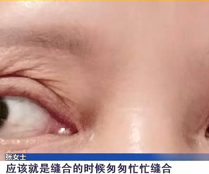 女子割个双眼皮也能“大出血” 南京星海荟医美维权退款难(图5)