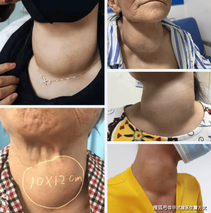 甲状腺肿大是怎么回事?是甲状腺结节吗?