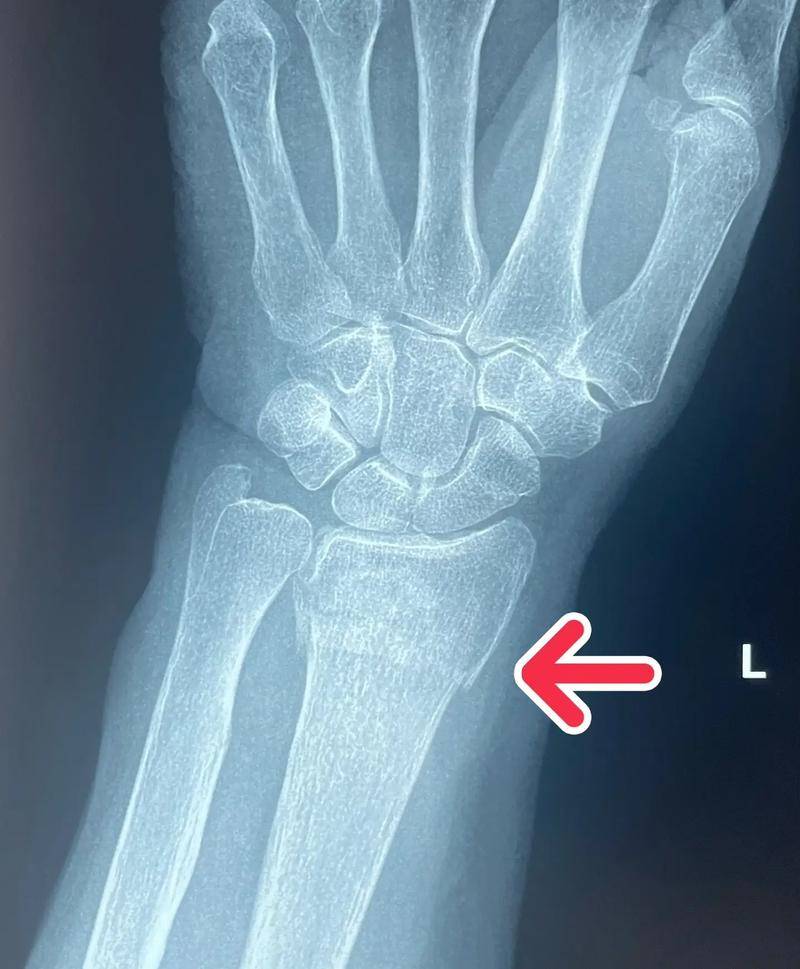 手腕关节骨头痛是怎么回事?真的是这个原因