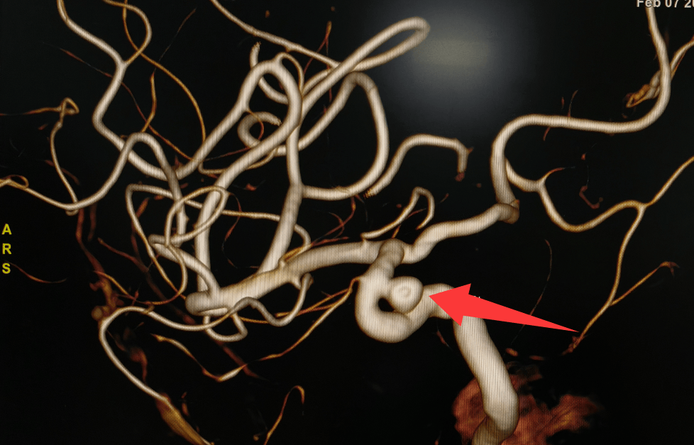 因疼痛去体检,发现颅内动脉瘤