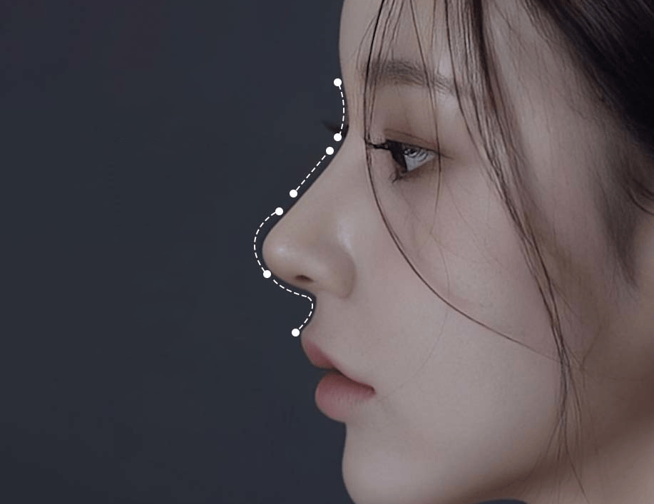折叠线:鼻梁较为突出的情况下,折叠线倾斜角度大,使得鼻子更为立体,有