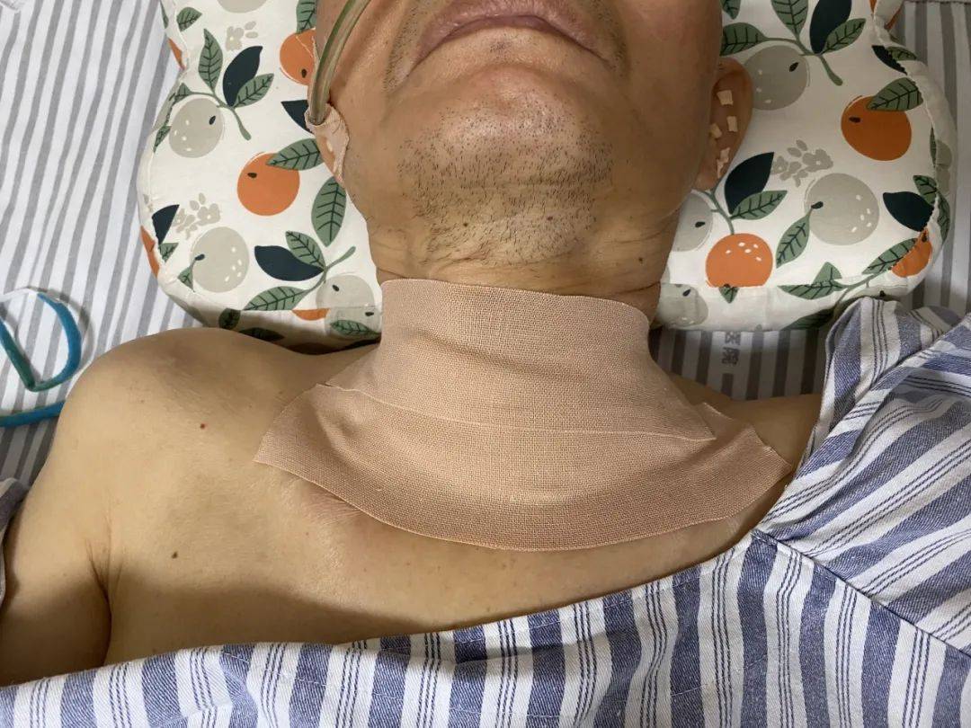 气管插管拔掉后的恢复