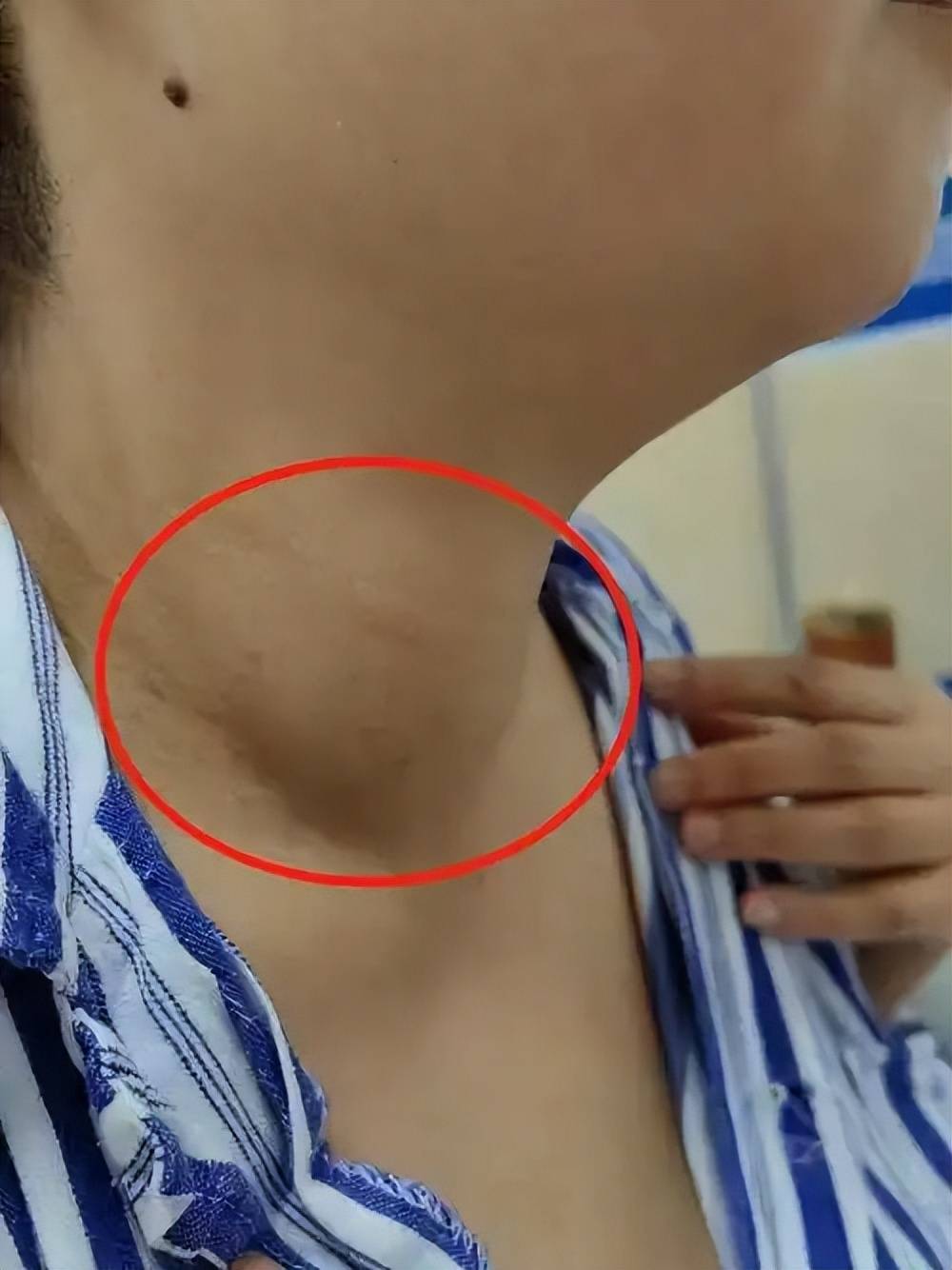 甲状腺结节超过多少厘米需要手术?李猛医生讲解手术红线,别盲目