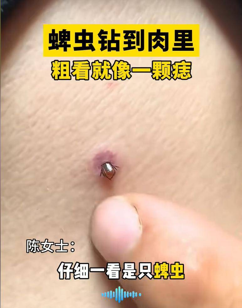 孩子被蜱虫咬阿婆手抠无果,妈妈一招救娃,网友:姨夫被蜱虫咬死