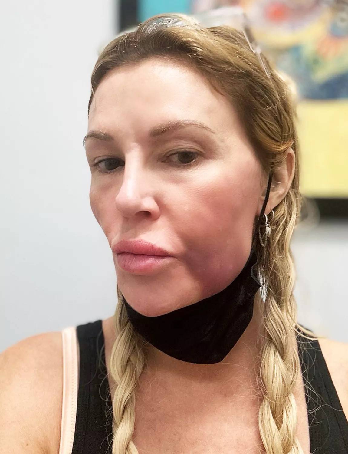 女星莫名毁容,被嘲讽整容失败.医生诊断被寄生虫"吃"掉了脸?