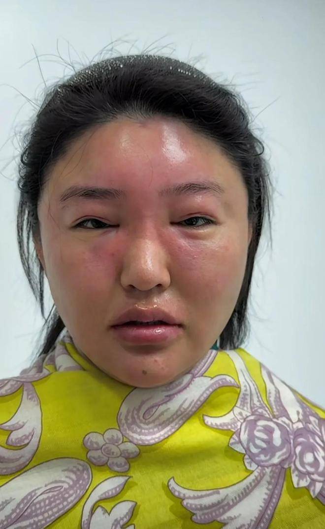 赵本山徒孙娇娇五一晒近照,全脸肿胀太吓人,网友:像猪头焖子!