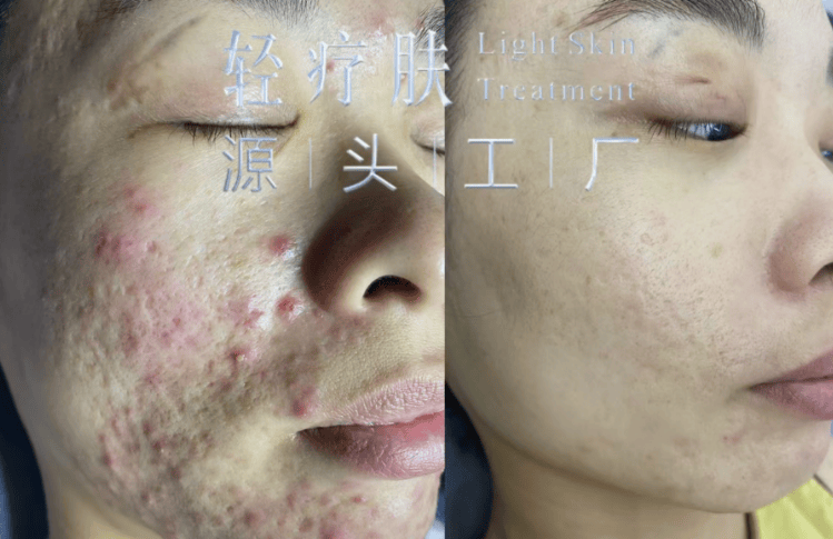 轻疗肤是正规品牌吗 轻疗肤可以祛斑吗