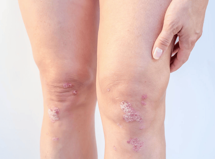 膝盖蔓延开的银屑病