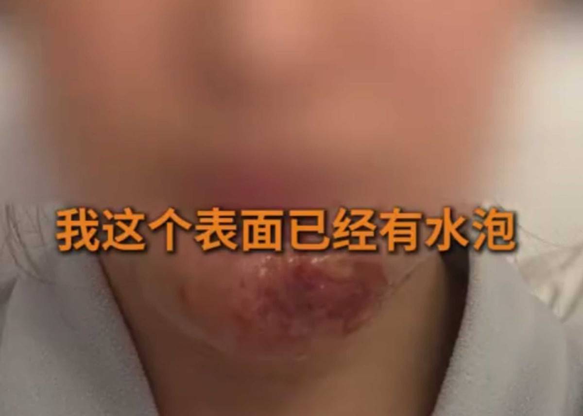 女子在徐州予美医美取生长因子烂脸 机构寄剪刀让其自行处理(图3)