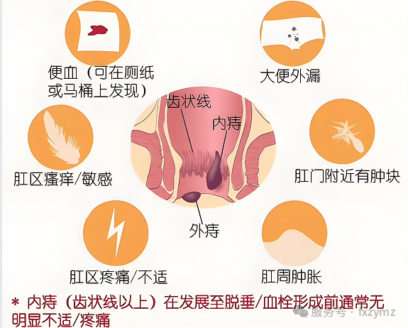 北京复兴路门诊中医肛肠讲四种常见脱肛是什么?