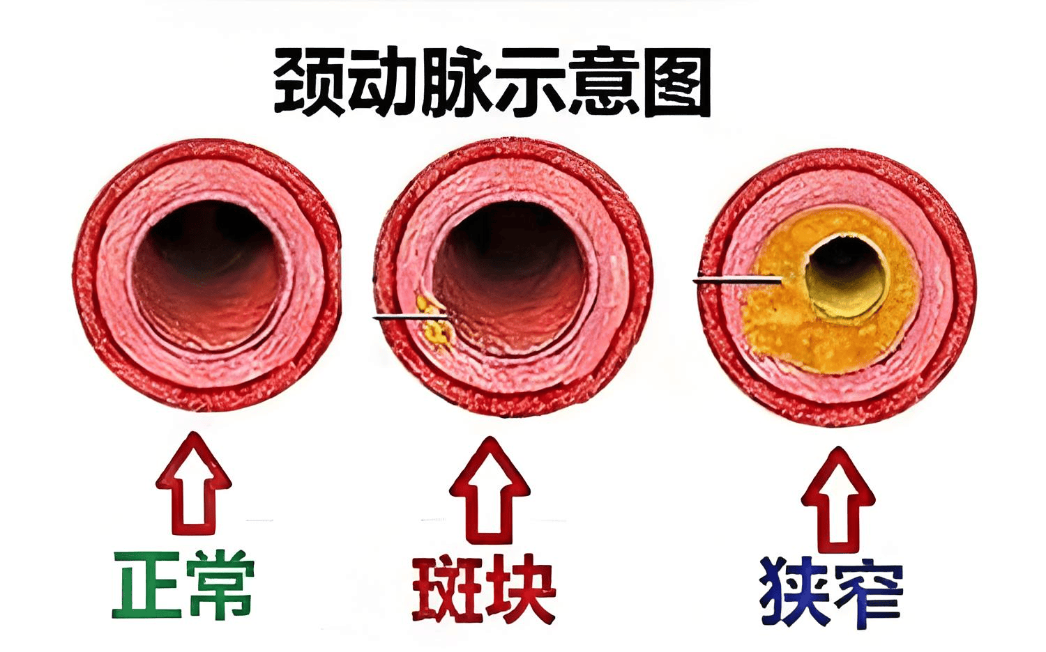 颈动脉斑块多大算严重?一文说清危险信号