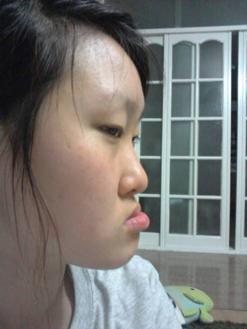 邢台牙齿矫正专家:为什么儿童地包天需及时治疗?