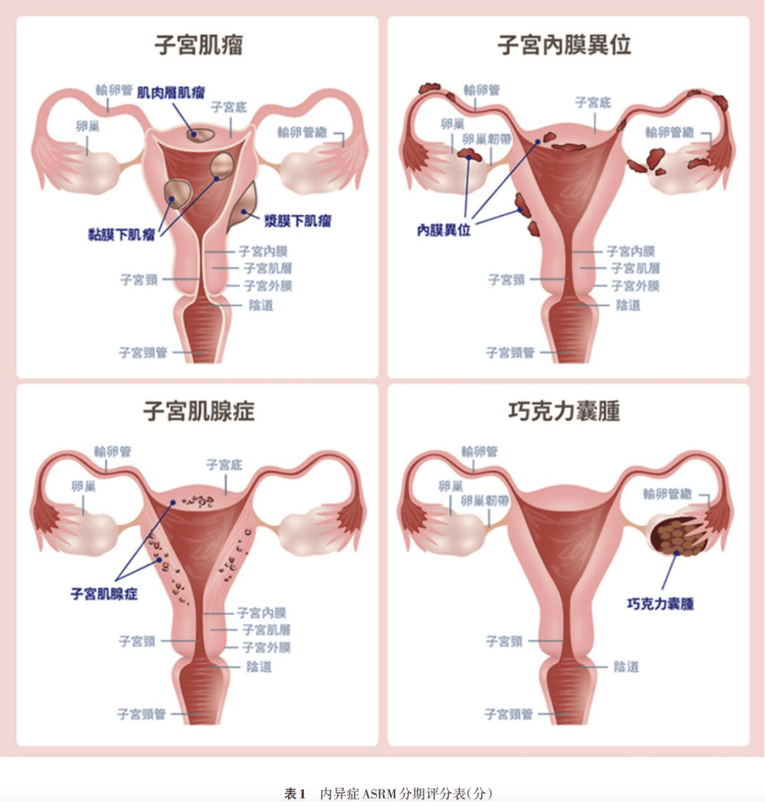 28 岁女子因痛经不孕,警惕内异症!邱学华教授这项技术为卵巢健康护航