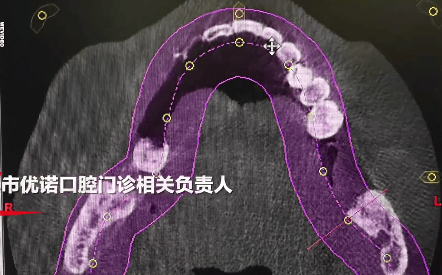 77岁老人拔12颗牙种植6颗牙后身亡:涉事医生停诊等待调查(图2)