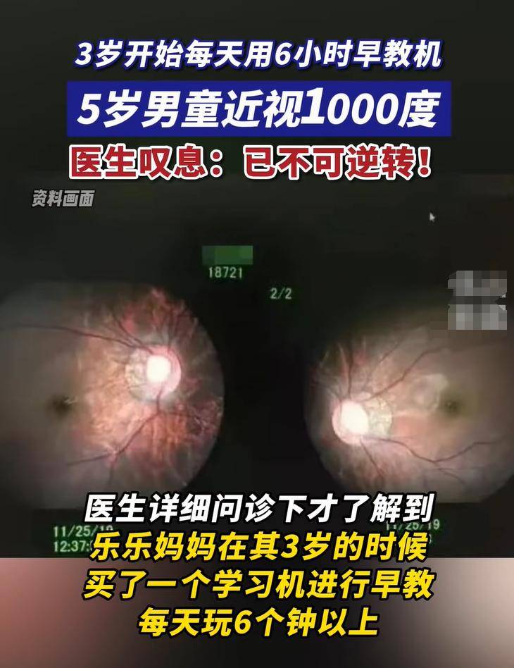 5岁孩子近视1000度,皆因父母拔苗助长,医生:基本瞎了