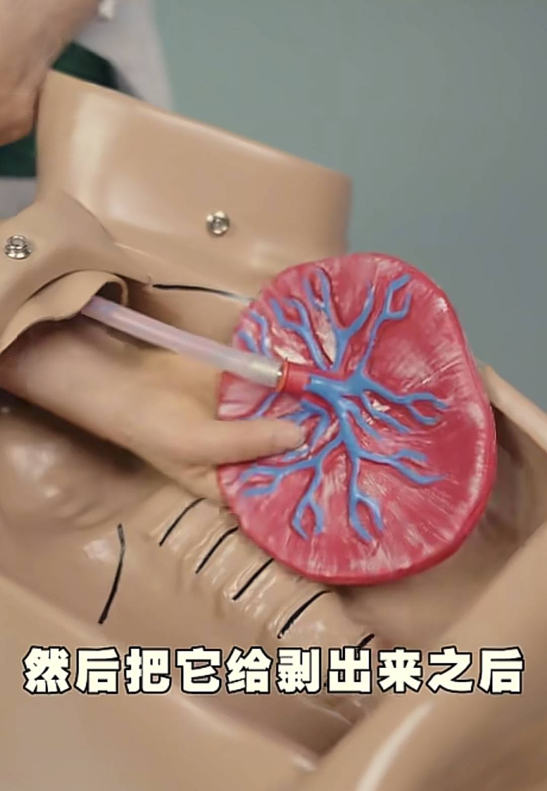 手剥胎盘为什么说大家都闻风丧胆呢？这个实操就告诉我们