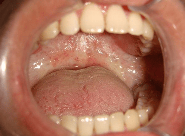 口腔纤维化≠不治之症!早检查早干预,让癌变风险无处遁形