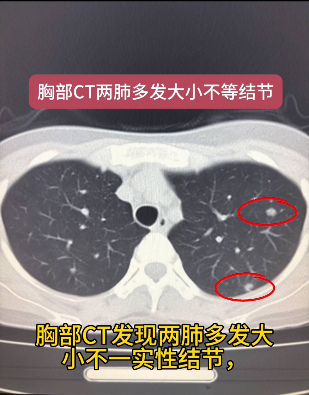 多发肺结节 六年前腮腺手术 考虑肺部转移