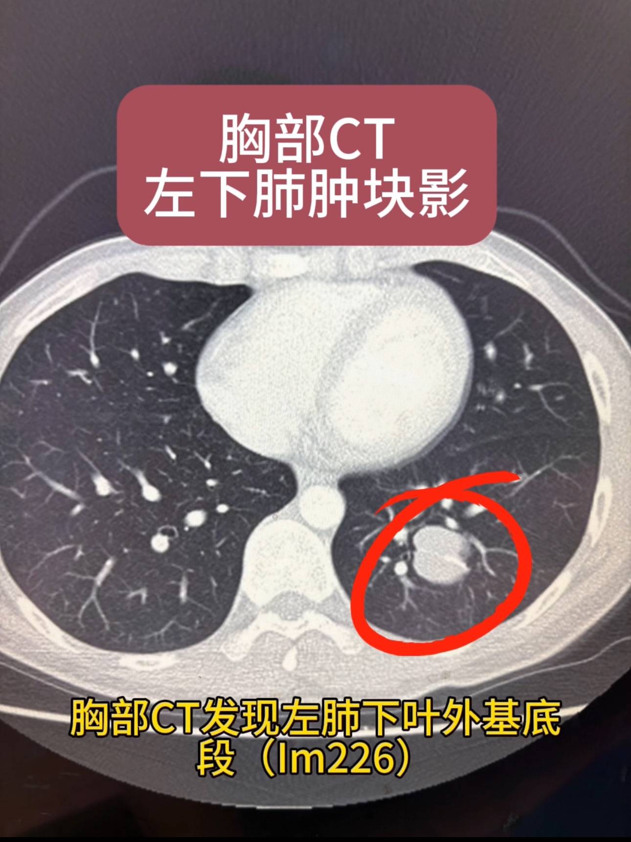 男性25岁胸部ct发现左肺下叶外基底段