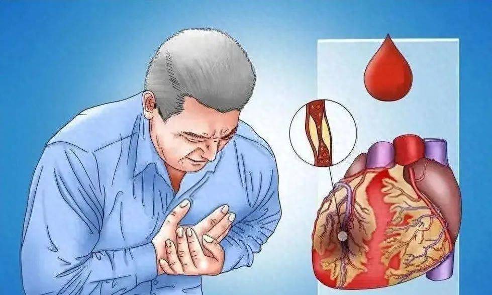原创            胸口像巨石碾压，喘不上气？小心心肌梗塞，别当成小毛病硬扛